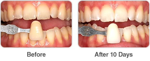 Opalescence Go 10% Before and After